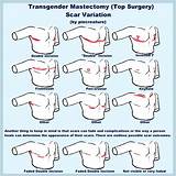 Effective Healing Techniques for Mastectomy Scars: a Comprehensive Guide